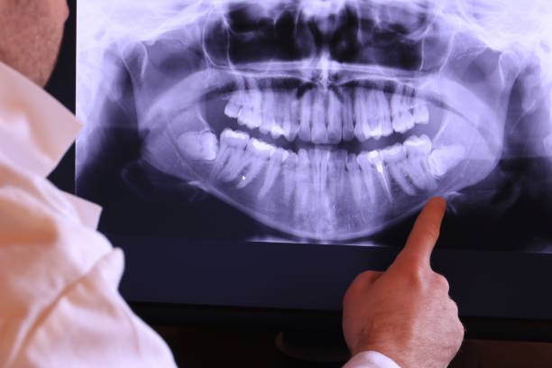 Best Knocked-Out Tooth (Avulsed Tooth) Treatment in Middlesex, NJ